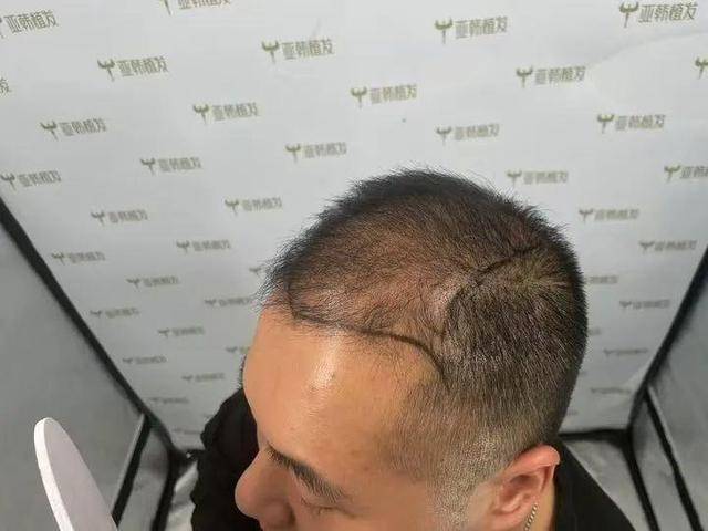 “还能反光<strong></p>
<p>XRP交易</strong>！”长沙男子植发近9月称后脑勺“像狗啃过”