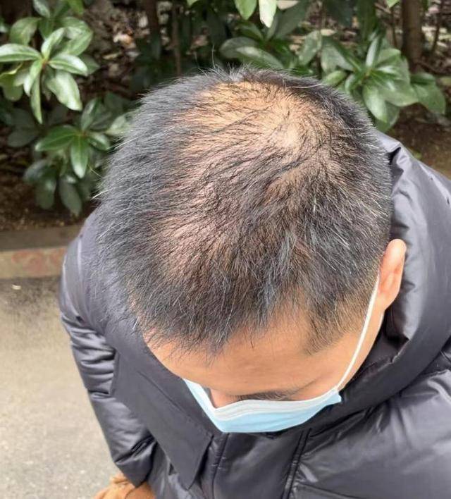 “还能反光<strong></p>
<p>XRP交易</strong>！”长沙男子植发近9月称后脑勺“像狗啃过”