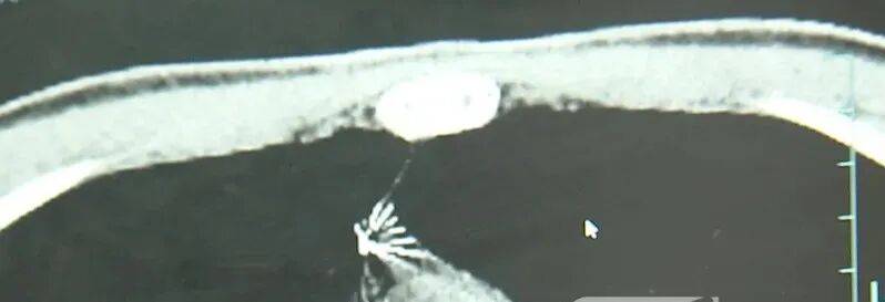 17岁小伙参军体检发现胸腔内有根5cm缝衣针<strong></p>
<p>中国出虚拟币</strong>,父母回忆或是1岁时扎入,取出时已锈迹斑斑