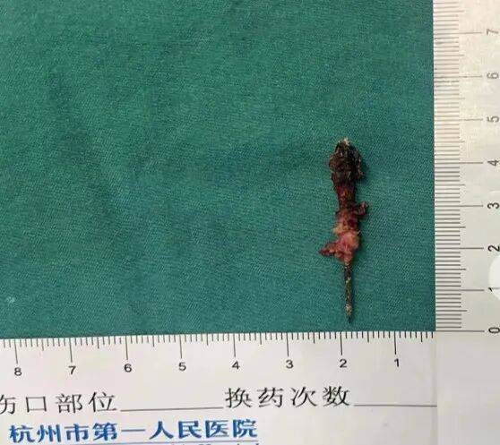 17岁小伙参军体检发现胸腔内有根5cm缝衣针<strong></p>
<p>中国出虚拟币</strong>,父母回忆或是1岁时扎入,取出时已锈迹斑斑